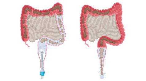 Coloplast Care – Transanal irrigation